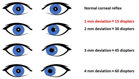 corneal reflex test results|Moran CORE .